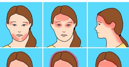 6 видов головной боли, которые нельзя терпеть - Все Для Женщины (ВДЖ)