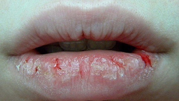 Сухость губ: причины, лечение, симптомы. отзывы, в уголках ...